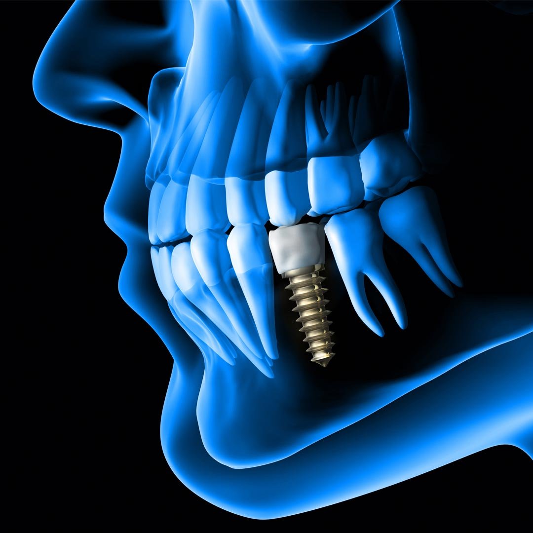 Affordable Dental Implants in Dubai