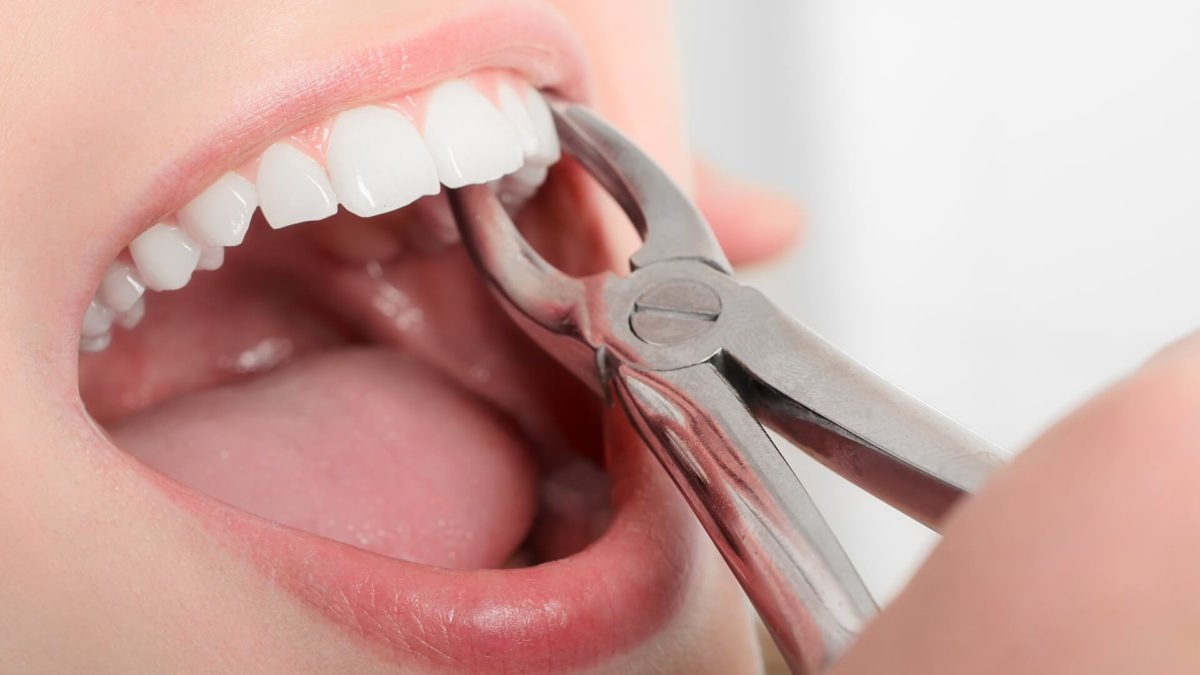 dental extraction NYC